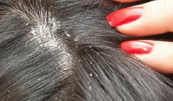 4 Media penularan kutu rambut dan 9 Cara membasminya dengan mudah dan aman