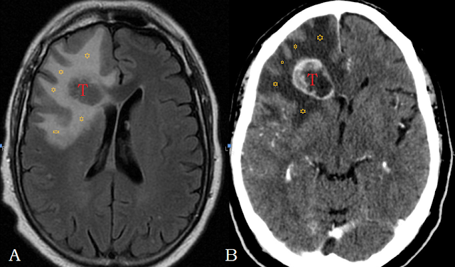 prostata con area pseudonodulare in t2 e stir