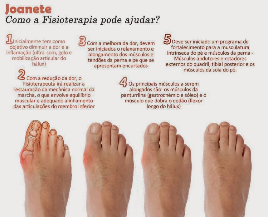 Podologia saúde ao seus pés... Hálux valgo Podologia saúde ao seus pés... Hálux valgo