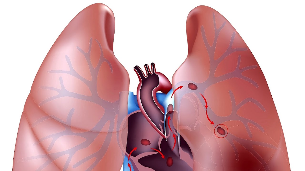 How To Treat A Blood Clot In The Lung Treat Choices