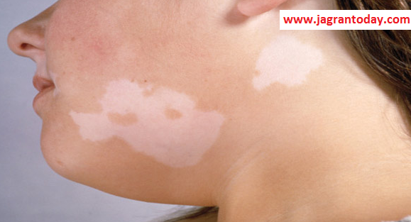 Home Aayurvedic Remedies for Leucoderma or White Spots