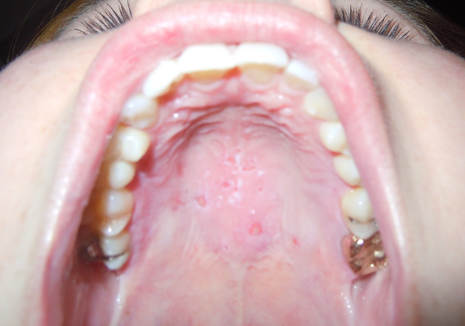 Fever Blister In Mouth 49