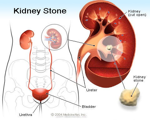 Baking Soda For Kidney Stones