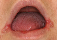 Hasil gambar untuk luka sudut bibir / Angular cheilitis