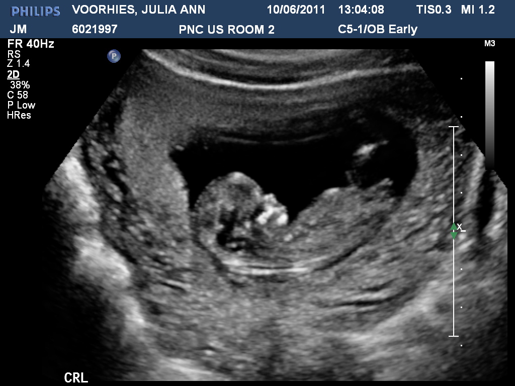 Baby Voorhies 12 Ultrasound