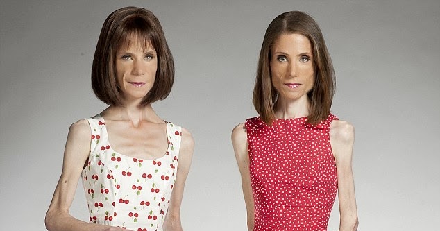 10 Most Shocking Cases Of Anorexia Zabavnik 387 