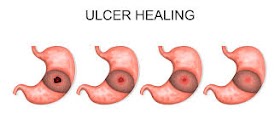 Stomach Ulcer Causes and Cure  معدے کا السر
