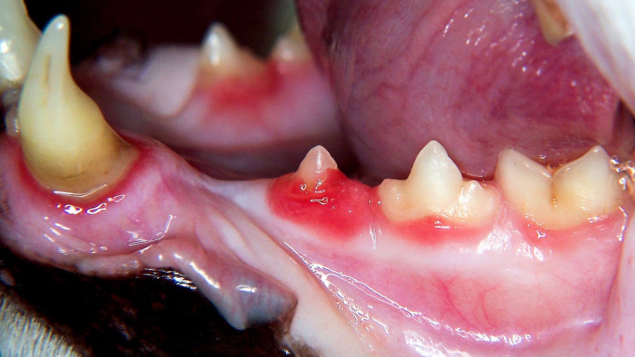 Plaque On Teeth And Heart Disease Hear Choices