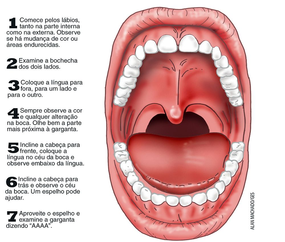 Cáncer Oral