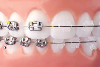 Benefícios da Ortodontia
