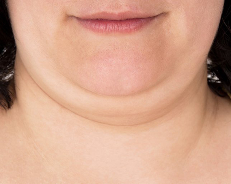 Dagu Berlipat Bikin Tak Pede, Lakukan 7 Cara Ini Untuk Mengatasinya