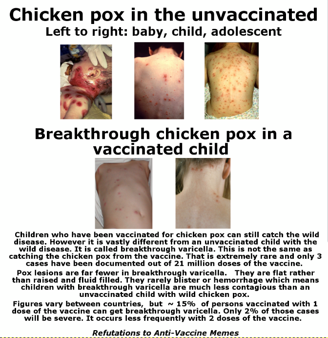 Before Vaccines Too Close for Comfort Rahel’s Experience with Chicken Pox