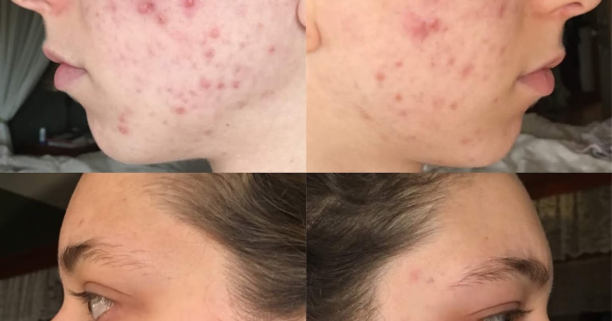 Aloe Vera Plant For Acne Before And After Plantă Blog