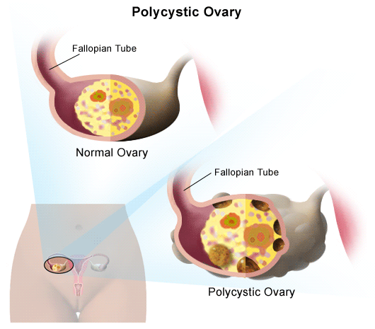 如何改善多囊性卵巢症候群幫助懷孕增加受孕機率