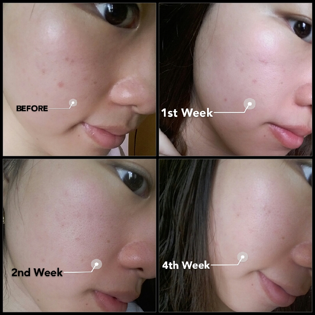 [Review] Banish Acne Scars Kit