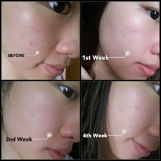 Review Banish Acne Scars Kit