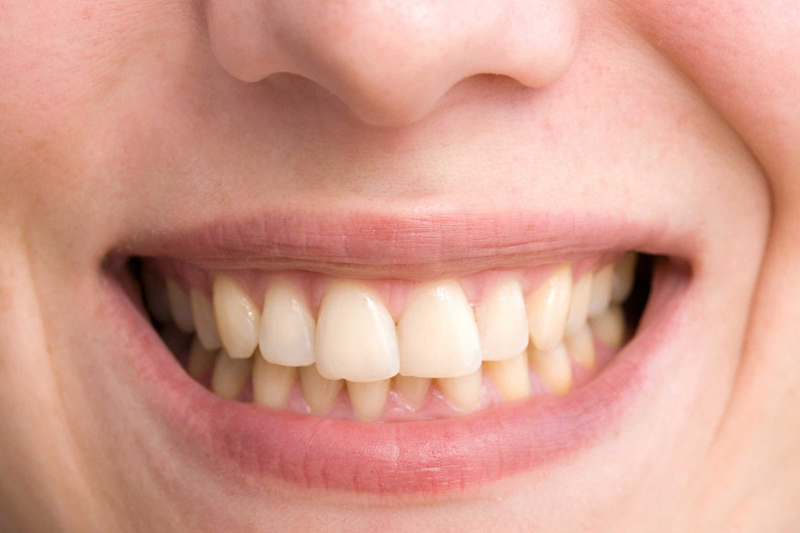 Your teeth will be yellow 12 Ways Smoking Cigarettes Ruins Your Looks