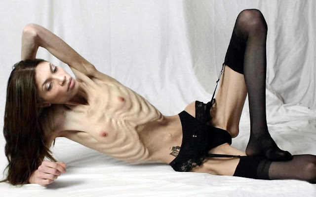 Model med ekstrem anoreksi