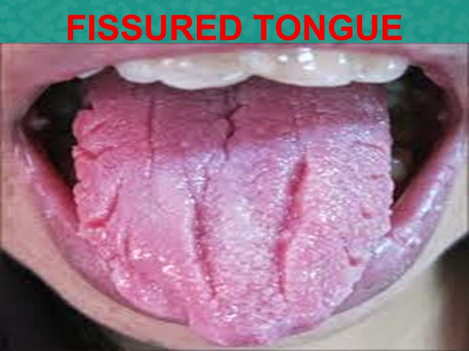 المدونة الطبية دفهيد سالم السبيعي Fissured Tongue