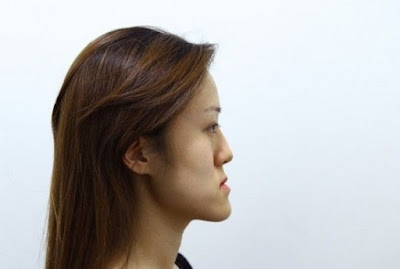 Phẫu thuật chỉnh hàm móm an toàn và triệt để sau 2h Phẫu thuật chỉnh hàm móm an toàn và triệt để sau 2h