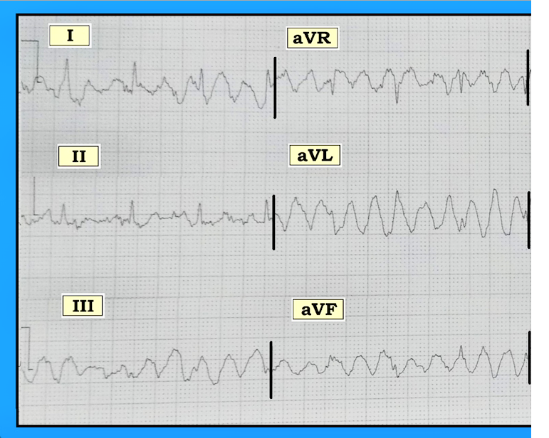 ECG Interpretation ECG Blog 148 (Ventricular Fibrillation VFib