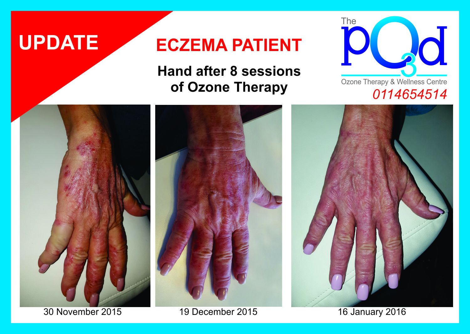 The Ozone Pod Ozone Treatment helps Eczema Patient