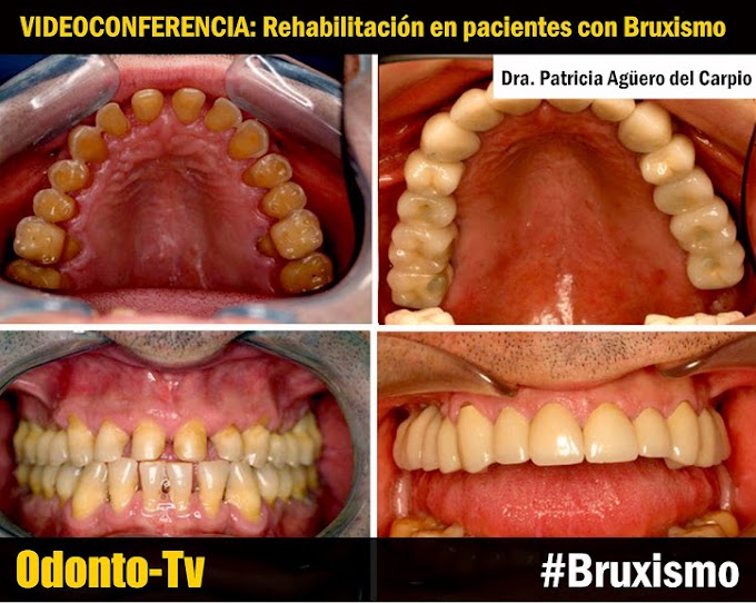 VIDEOCONFERENCIA: Rehabilitación en pacientes con Bruxismo - Dra. Patricia Agüero del Carpio