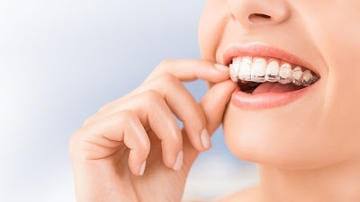 Ưu điểm của kỹ thuật niềng răng không mắc cài 3D clear 