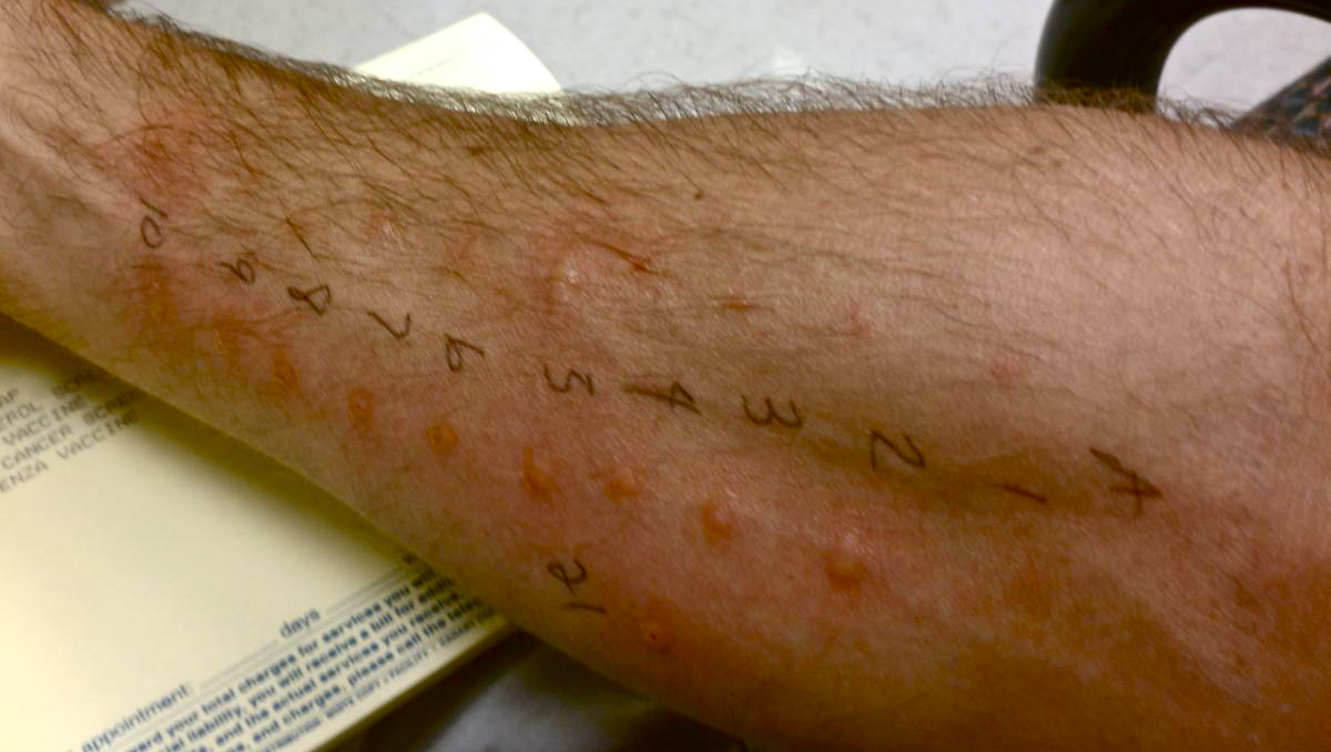 Daily Finds allergy test arm find