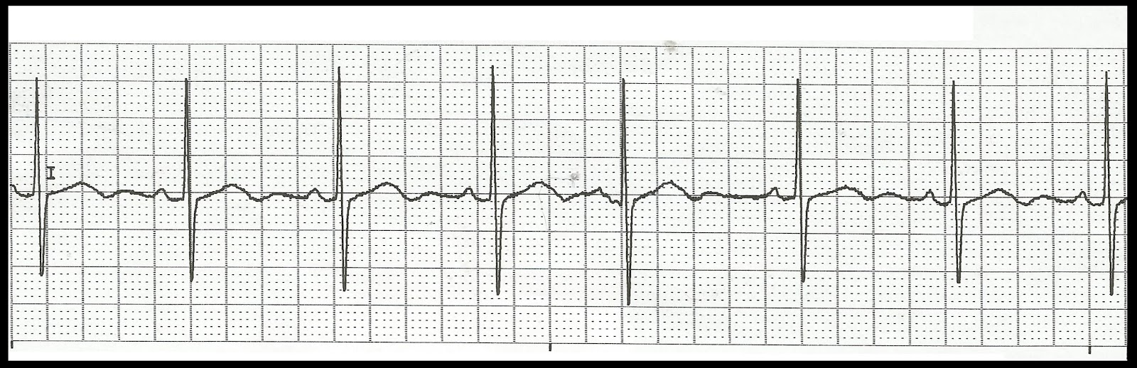 Practice EKG Rhythm Strips 170