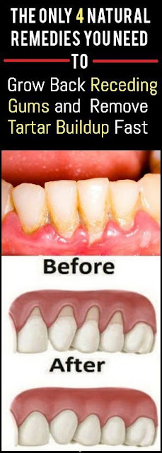 The Only 4 Natural Remedies You Need To Grow Back Receding Gums and Remove Tartar Buildup Fast