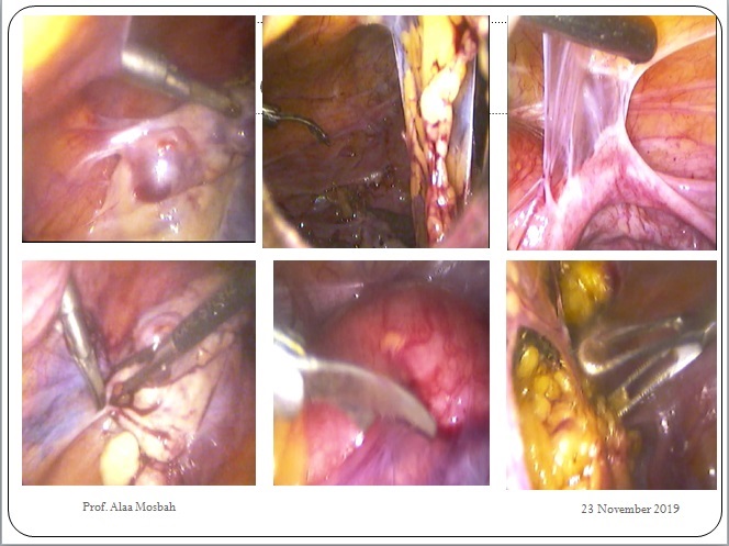 Laparoscopy for a case with severe adhesions- Adhesolysis was done by Dr. Alaa Mosbah