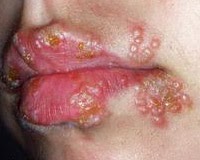 Penyakit Herpes Mulut