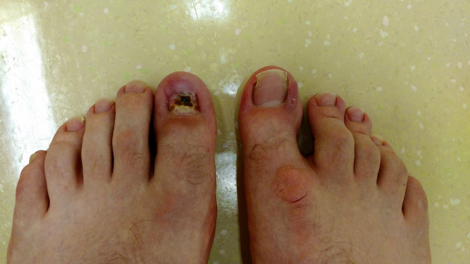 Bees' Nest Getting my *Other* Ingrown Toenail Removed