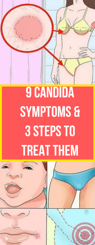 9 Candida Symptoms And 3 Steps To Treat Them Mysmartips