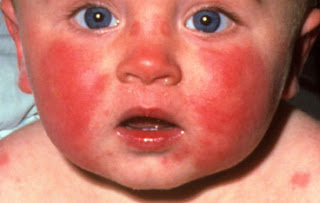 Heat Rash or Prickly Heat (Miliaria Rubra) in an Infant or ...