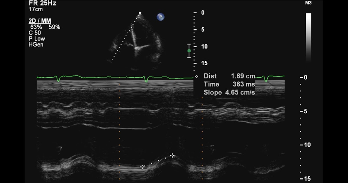 Andrew R. Houghton The prognostic value of TAPSE in acute PE