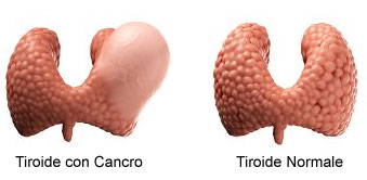 Tumore  della tiroide: cos'è e quali forme può assumere