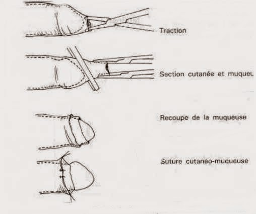 Обрезание при фимозе у детей. Циркумцизио (обрезание крайней плоти) (схема 2).