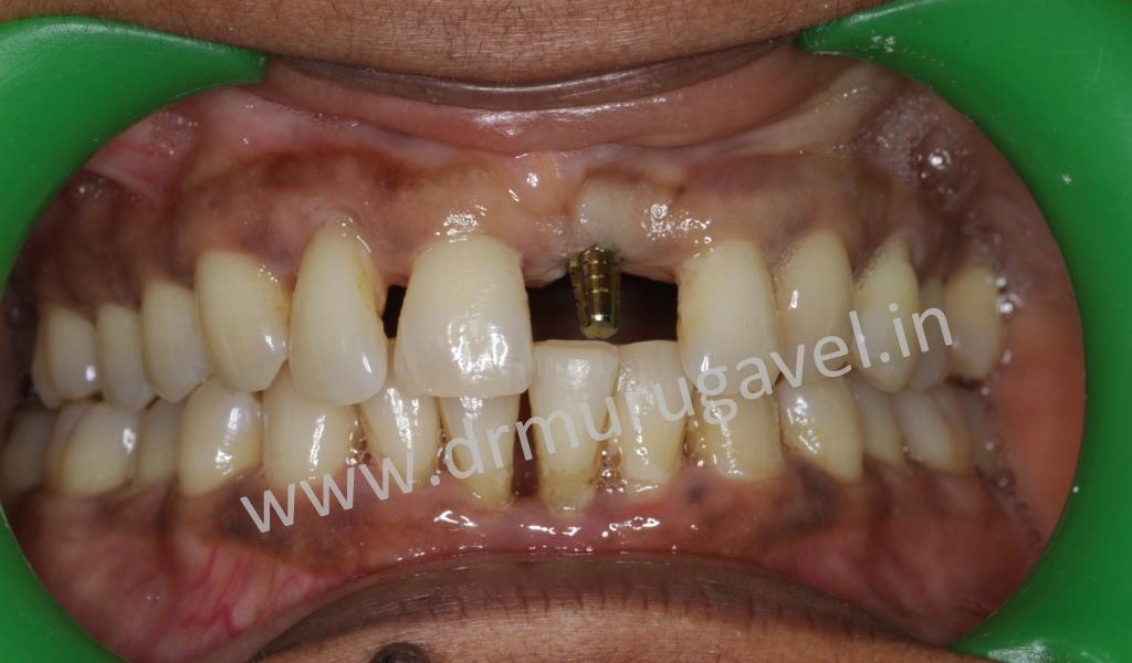 Front teeth esthetic replacement with dental implantswithout bone