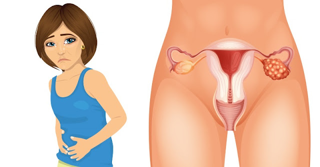 4 Early Symptoms Of Ovarian Cancer That Every Woman Needs To Know.