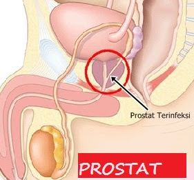 Penyakit Pria - Cara Mengobati Penyakit Prostat Secara Alami 