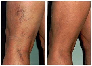 Vein Care