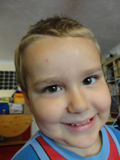 Big Boy with Scabbing over Chicken Pox