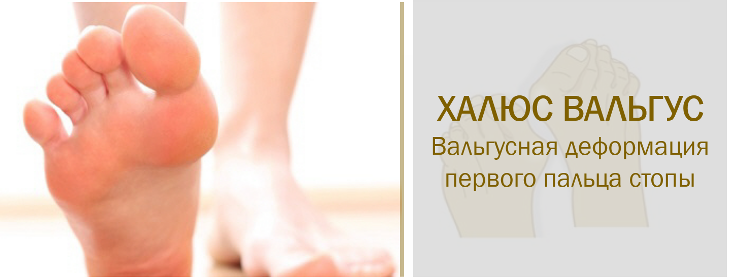 Больница Уридыль - Сеул Аэропорт Гимпо: Халюс Вальгус / Вальгусная ...