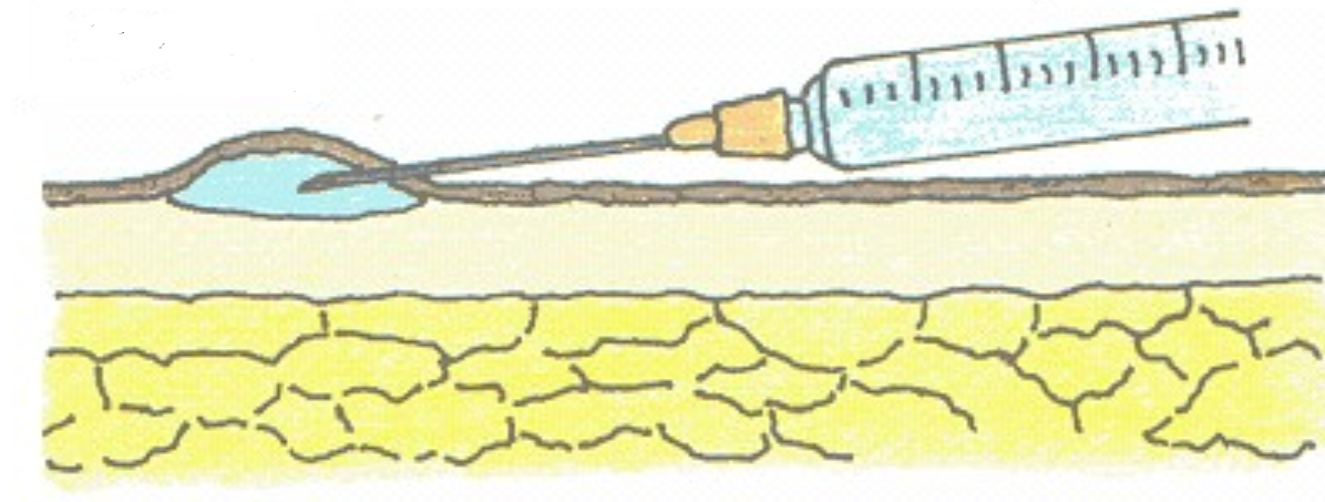 0.1 CC - VÍA INTRADERMICA