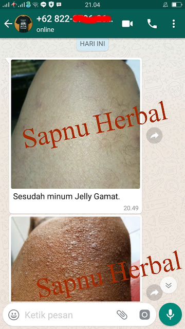 Obat Gatal Di Selangkangan Dan Kelamin Tradisional Terbukti Mujarab ~ TESTIMONI QNC JELLY GAMAT Obat Gatal Di Selangkangan Dan Kelamin Tradisional Terbukti Mujarab ~ TESTIMONI QNC JELLY GAMAT