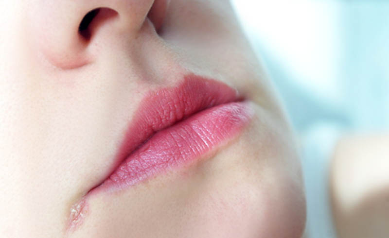Why The Corners Of Your Mouth Crack — & How To Fix It Why The Corners Of Your Mouth Crack — & How To Fix It