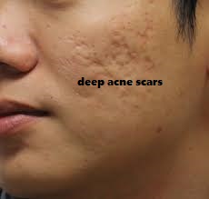 How to Cure Deep Acne Scars on Face Fast Naturally