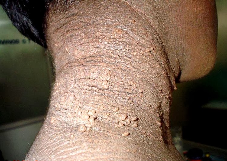 picture of acanthosis nigricans affected neck of a child